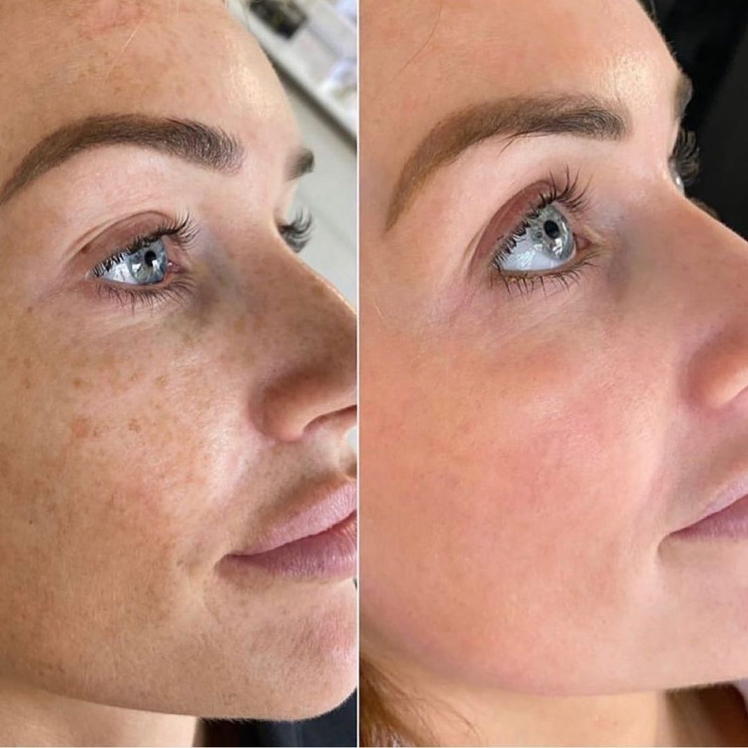 PRX Collagen Biostimulator Treatment in West Palm Beach